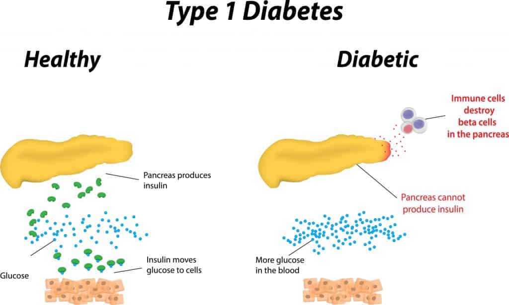type 1 and type 2: a Type 1 diabetes graph showing the difference between a healthy pancreas process and a diabetic pancreas process.