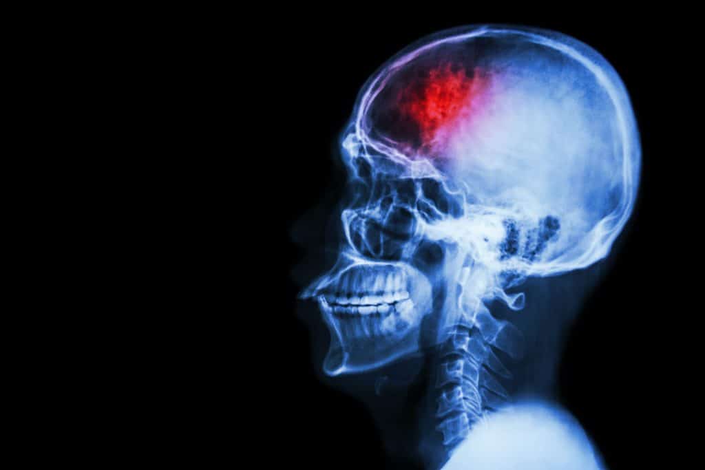 What is CTE Disease