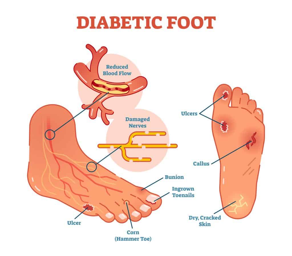 Diabetic Foot Care Tips