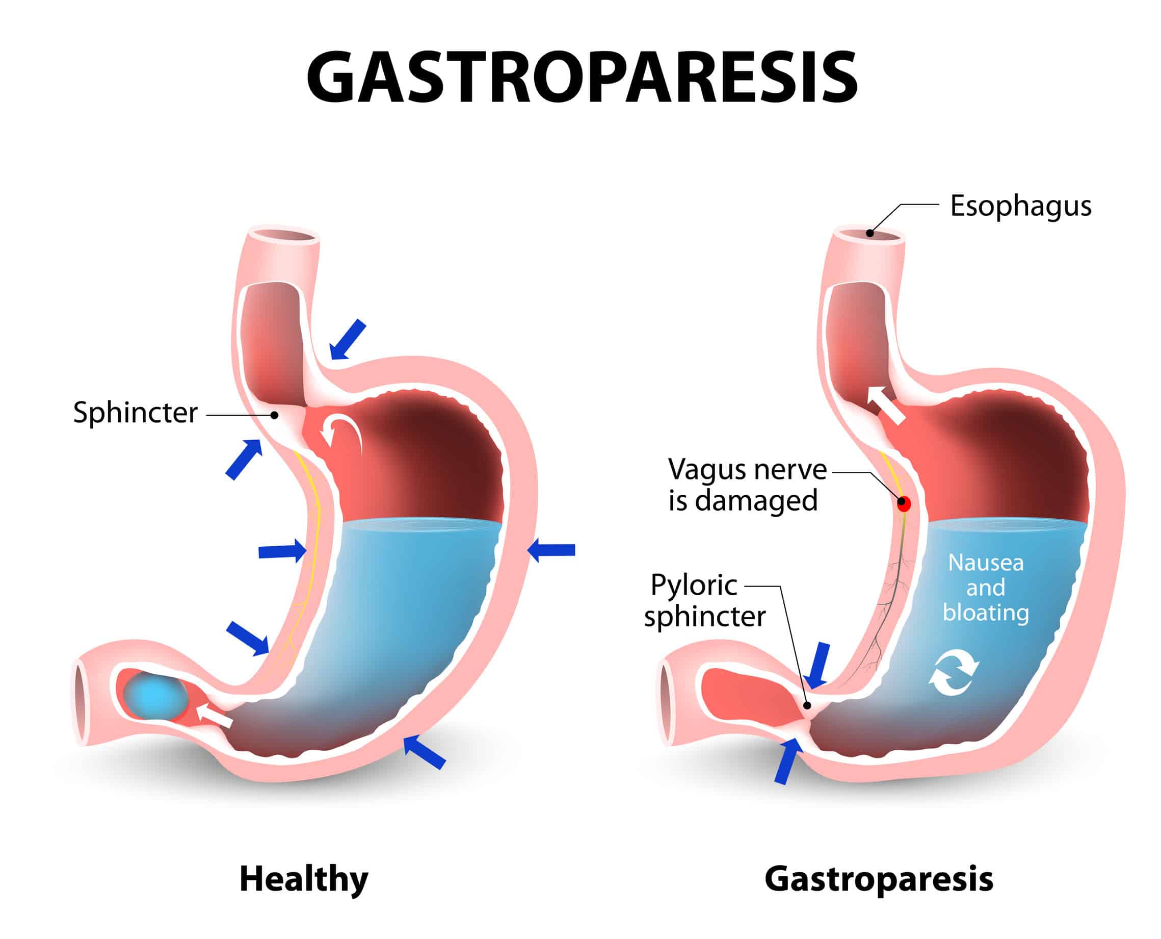 Medical visual representing diabetic gastroparesis